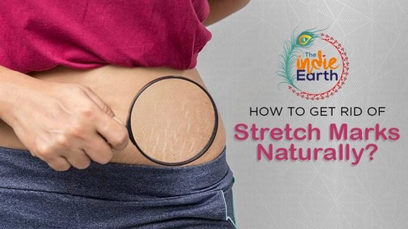 How-to-get-rid-of-Stretch-Marks-Naturally1